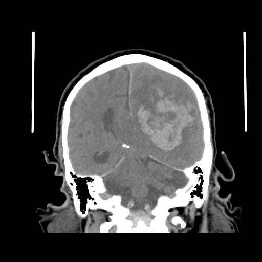 Acute hemorrhagic stroke (Radiopaedia 17507-17223 Coronal non-contrast 34).jpg