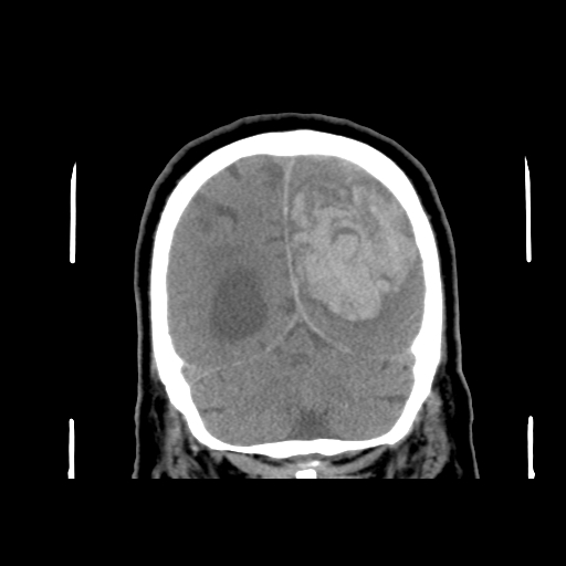 Acute hemorrhagic stroke (Radiopaedia 17507-17223 Coronal non-contrast 44).jpg