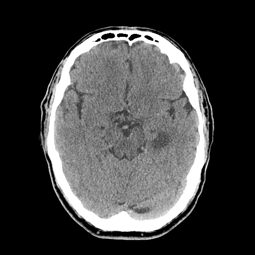 File:Acute hippocampal infarction (Radiopaedia 10610-11071 non-contrast 6).jpg