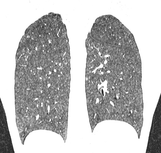 Acute hypersensitivity pneumonitis (Radiopaedia 85293-100870 Coronal lung window 100).jpg