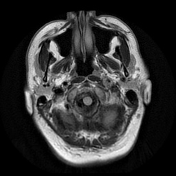 File:Acute internal carotid artery dissection (Radiopaedia 53541-59632 Axial FLAIR 2).jpg