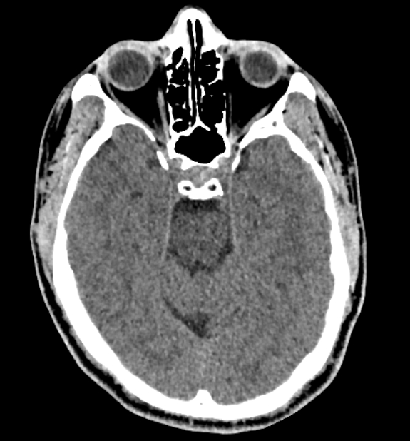 Acute ischemic stroke - posterior circulation territory (Radiopaedia 77670-89881 non-contrast 31).jpg