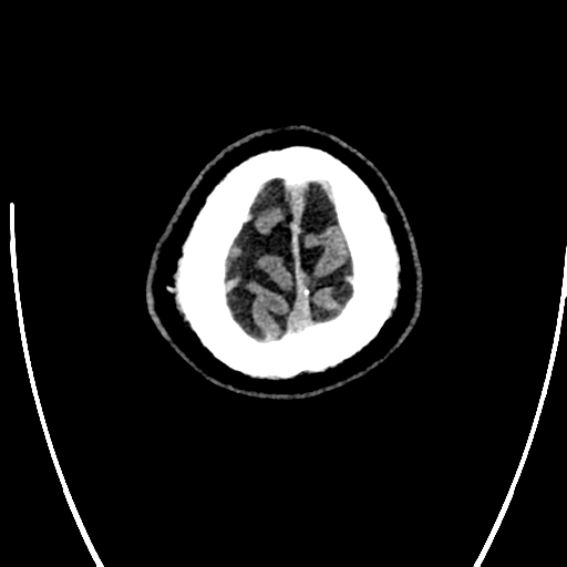 Acute left middle cerebral artery territory ischemic stroke (Radiopaedia 35688-37223 Axial non-contrast 84).png
