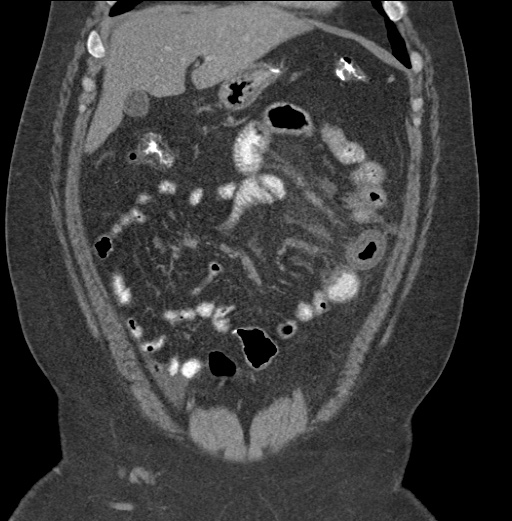 Acute mesenteric venous ischemia (Radiopaedia 46041-50383 Coronal C+ portal venous phase 28).jpg