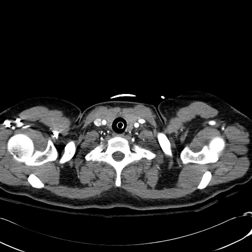 Acute myocardial infarction in CT (Radiopaedia 39947-42415 Axial C+ arterial phase 1).jpg