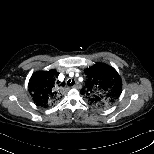File:Acute myocardial infarction in CT (Radiopaedia 39947-42415 Axial C+ arterial phase 31).jpg