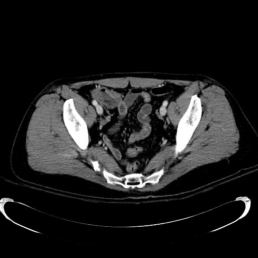 Acute myocardial infarction in CT (Radiopaedia 39947-42415 Axial C+ portal venous phase 112).jpg