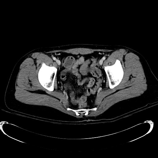 Acute myocardial infarction in CT (Radiopaedia 39947-42415 Axial C+ portal venous phase 119).jpg
