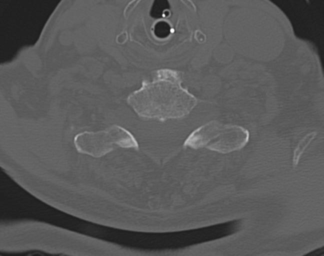 Acute on chronic subdural hematoma and thoracic vertebral injury in a multitrauma patient (Radiopaedia 31698-32619 Axial bone window 47).jpg