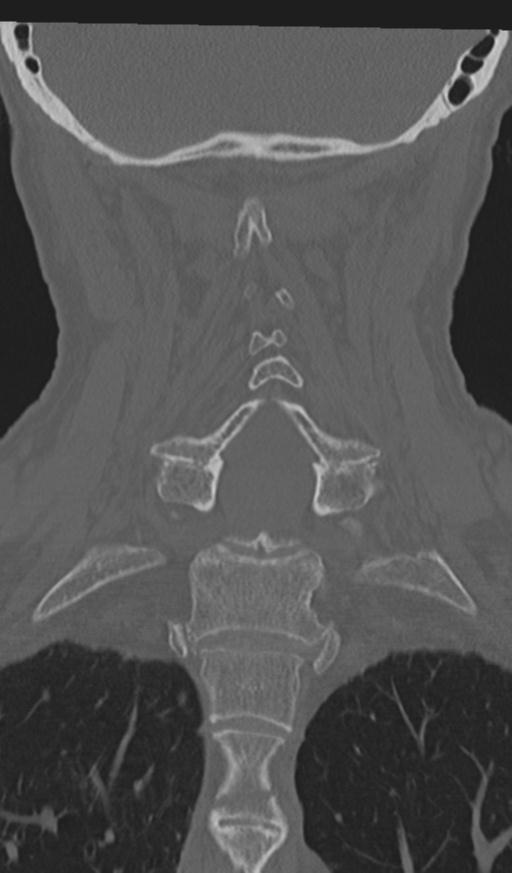 Acute on chronic subdural hematoma and thoracic vertebral injury in a multitrauma patient (Radiopaedia 31698-32619 Coronal bone window 40).jpg