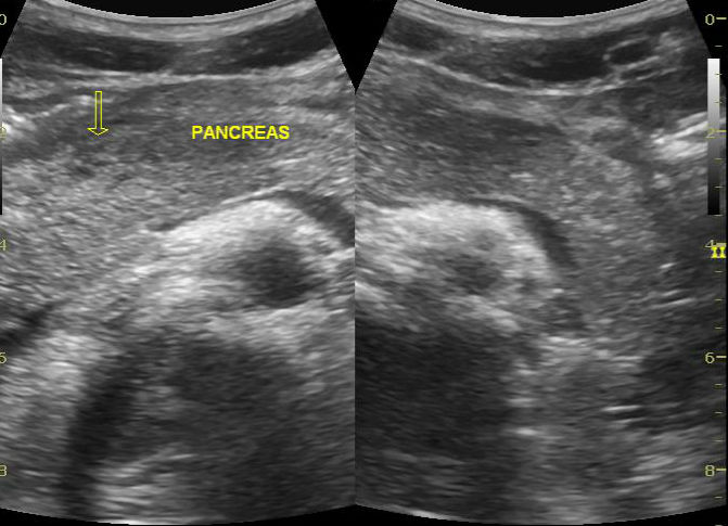 File:Acute pancreatitis (Radiopaedia 23045-23075 B 1).jpg