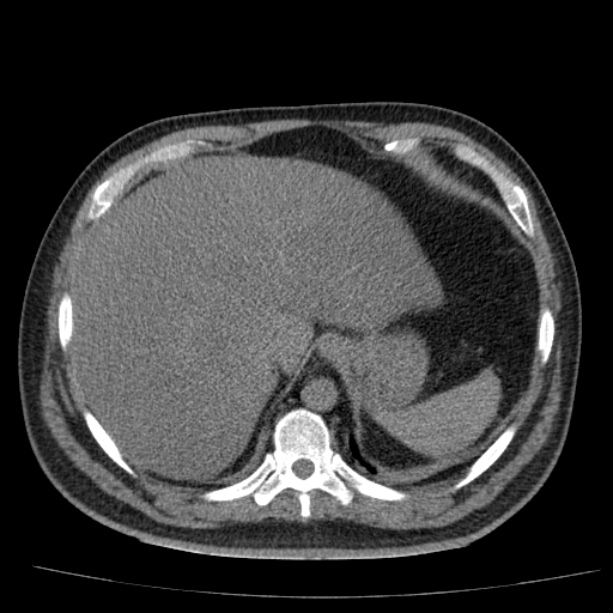 Acute pancreatitis (Radiopaedia 26663-26813 Axial non-contrast 21).jpg