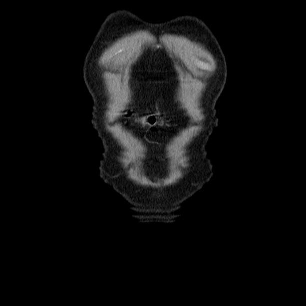 Acute pancreatitis (Radiopaedia 26663-26813 Coronal C+ portal venous phase 5).jpg