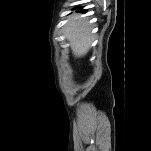 Acute pancreatitis (Radiopaedia 26663-26813 Sagittal C+ portal venous phase 7).jpg