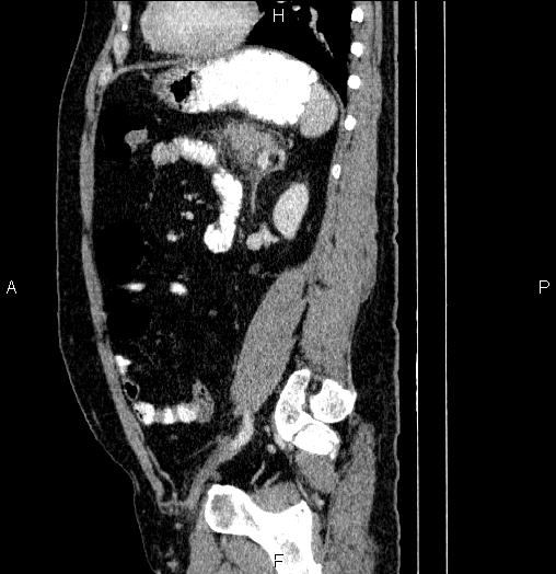 Acute pancreatitis (Radiopaedia 85390-101010 Sagittal C+ portal venous phase 69).jpg
