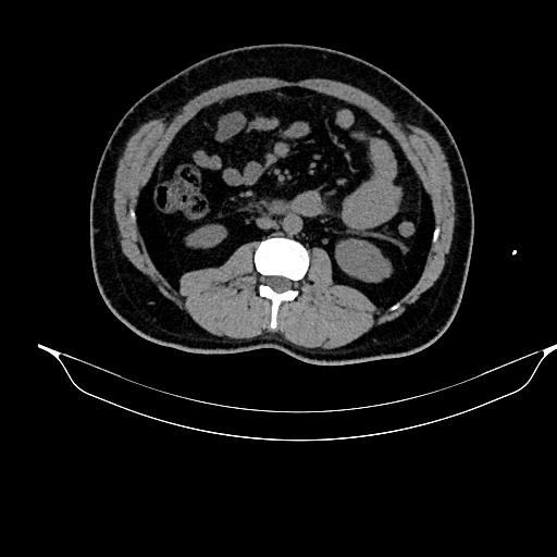 File:Acute pancreatitis (Radiopaedia 87428-103757 Axial non-contrast 49).jpg
