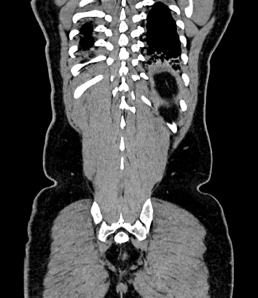 Acute pancreatitis (Radiopaedia 87428-103757 Coronal C+ portal venous phase 81).jpg