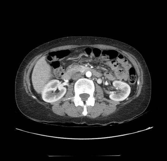 File:Acute pancreatitis - Balthazar E - post ERCP (Radiopaedia 27562-27772 Axial C+ arterial phase 26).png