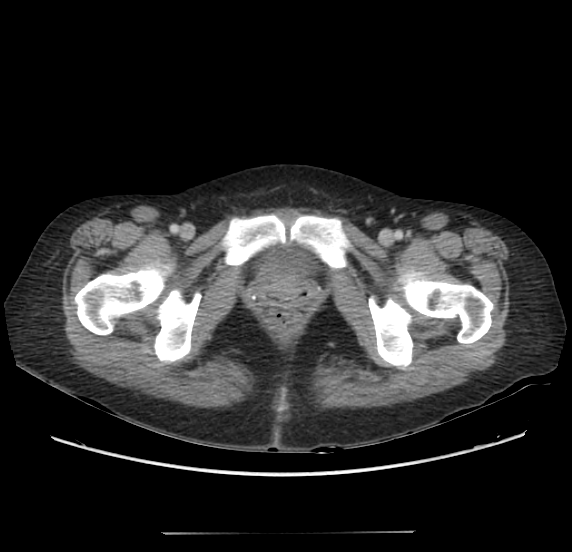 File:Acute pancreatitis - Balthazar E - post ERCP (Radiopaedia 27562-27772 Axial C+ portal venous phase 77).png