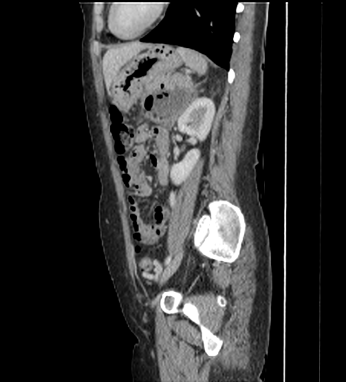 Acute pancreatitis - Balthazar E - post ERCP (Radiopaedia 27562-27772 Sagittal C+ portal venous phase 93).png