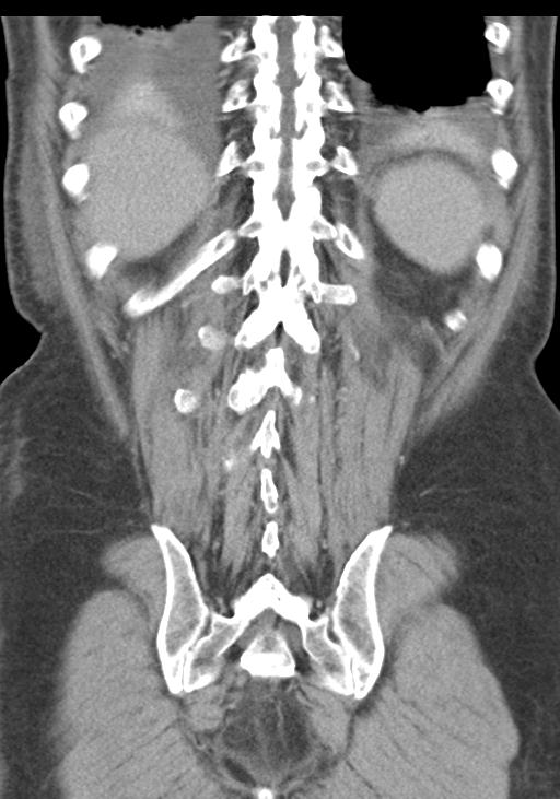 Acute pancreatitis and walled-off necrosis (Radiopaedia 29888-30403 E 47).jpg