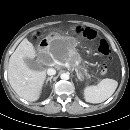 File:Acute pancreatitis and walled-off necrosis (Radiopaedia 29888-30404 Axial C+ portal venous phase 24).jpg