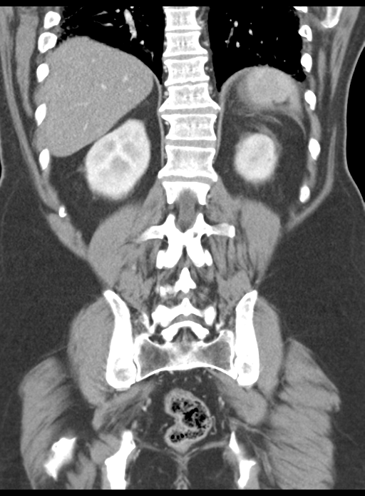 Acute pancreatitis complicated by portal vein thrombus (Radiopaedia 48148-52990 Coronal C+ portal venous phase 48).png