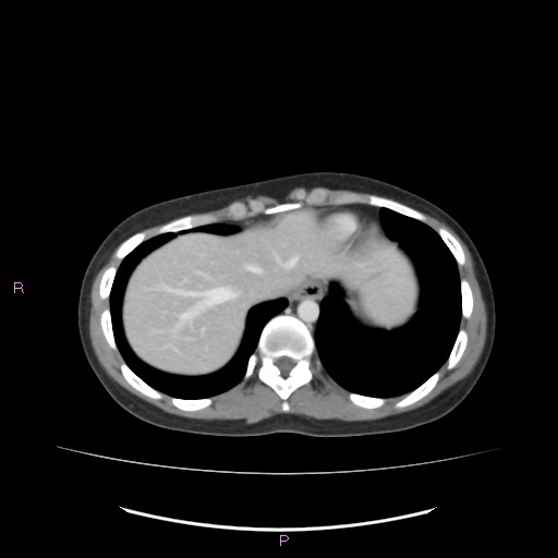 Acute pancreatitis secondary to stone at minor papilla and pancreatic divisum (Radiopaedia 76570-88333 Axial C+ portal venous phase 11).jpg