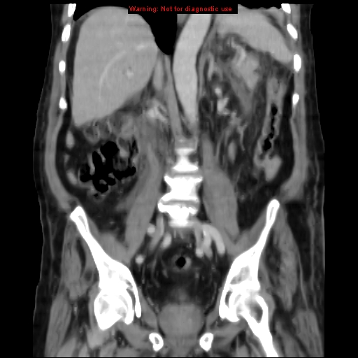 Acute pancreatitis with incidental pancreatic lipoma (Radiopaedia 10190-10730 Coronal C+ portal venous phase 42).jpg