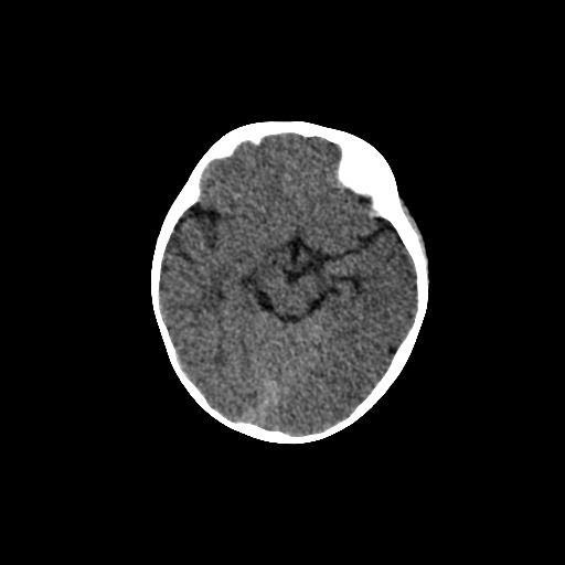 Acute phase of hemiconvulsion-hemiplegia epilepsy syndrome (Radiopaedia 29309-29744 Axial non-contrast 32).jpg