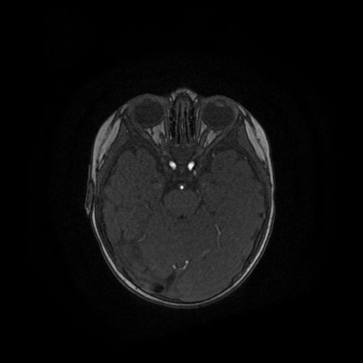 Acute phase of hemiconvulsion-hemiplegia epilepsy syndrome (Radiopaedia 29309-29745 Axial TOF angiography 95).jpg