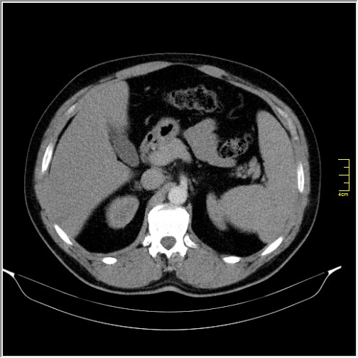Acute right sided diverticulitis (Radiopaedia 65249-74268 Axial C+ portal venous phase 22).JPG