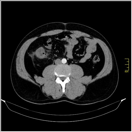 Acute right sided diverticulitis (Radiopaedia 65249-74268 Axial C+ portal venous phase 44).JPG