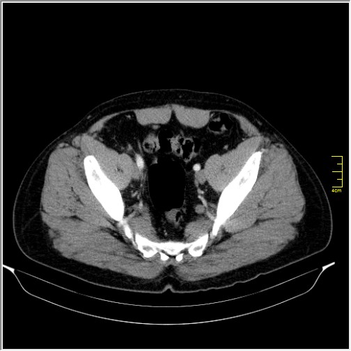 File:Acute right sided diverticulitis (Radiopaedia 65249-74268 Axial C+ portal venous phase 67).JPG