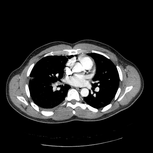 Acute segmental pulmonary emboli and pulmonary infarction (Radiopaedia 62264-70444 Axial C+ CTPA 60).jpg