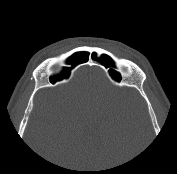 Acute sinusitis (Radiopaedia 23161-23215 Axial bone window 65).jpg