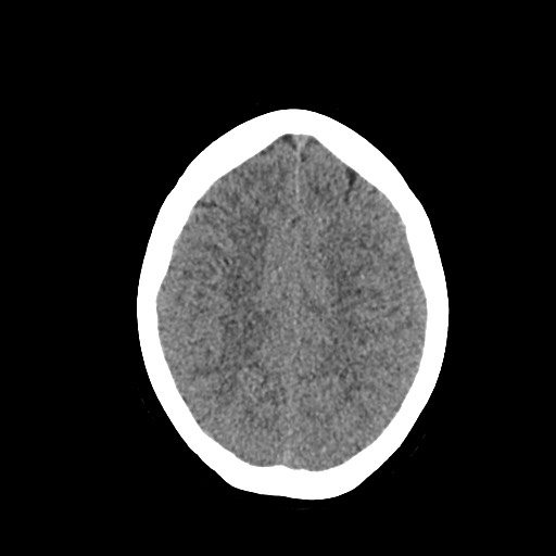 Acute subarachnoid hemorrhage and accessory anterior cerebral artery (Radiopaedia 69231-79008 Axial non-contrast 39).jpg