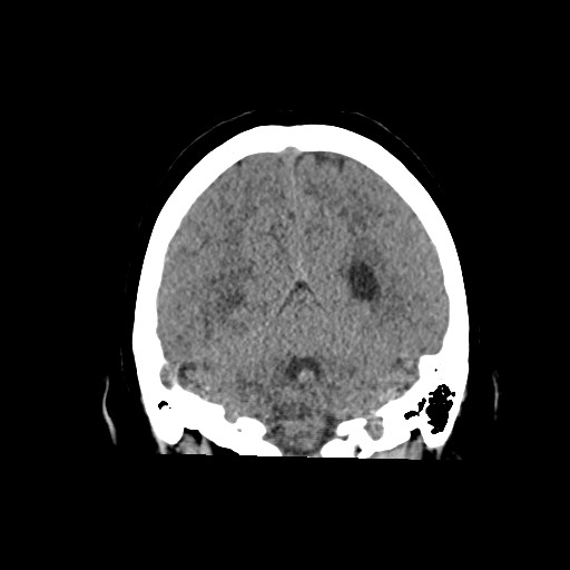 Acute subarachnoid hemorrhage and accessory anterior cerebral artery (Radiopaedia 69231-79008 Coronal non-contrast 51).jpg