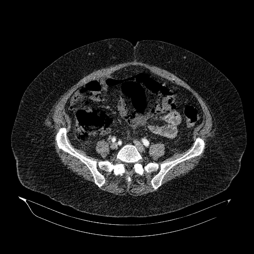 File:Acute superior mesenteric artery occlusion (Radiopaedia 51288-56960 Axial C+ arterial phase 65).jpg