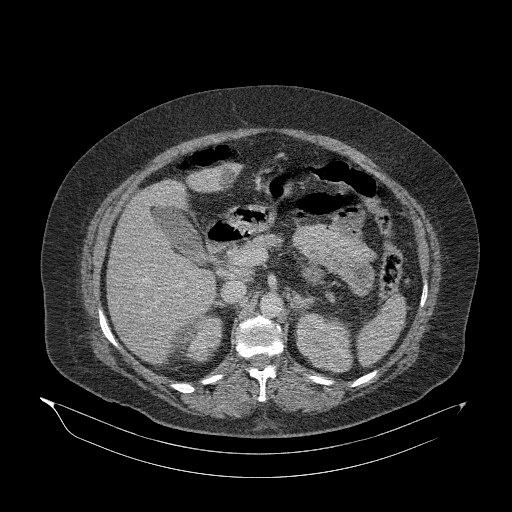 Acute superior mesenteric artery occlusion (Radiopaedia 51288-56960 Axial C+ portal venous phase 33).jpg