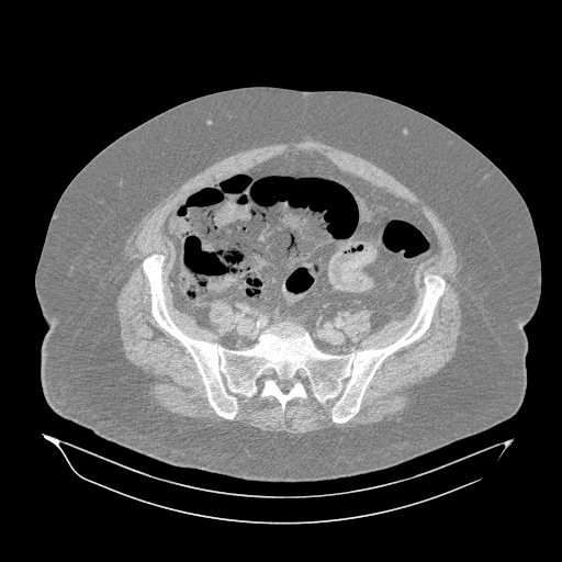 Acute superior mesenteric artery occlusion (Radiopaedia 51288-56960 Axial lung window 55).jpg