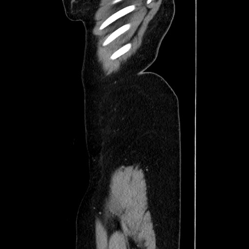 Acute uncomplicated appendicitis (Radiopaedia 73704-84499 Sagittal C+ portal venous phase 183).jpg