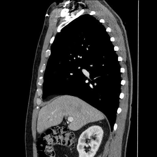 Adenocarcinoma of the lung (Radiopaedia 59871-67325 Sagittal C+ arterial phase 32).jpg