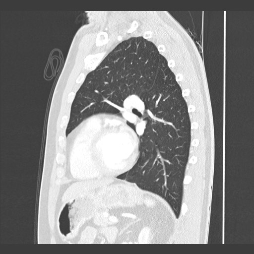 Adenocarcinoma of the lung (Radiopaedia 59871-67325 Sagittal lung window 66).jpg