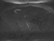 Adenocarcioma of rectum- T1 lesion (Radiopaedia 36921-38546 Axial DWI 80).png