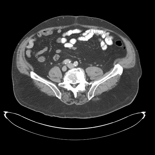Adenocarcioma of rectum- T1 lesion (Radiopaedia 36921-38547 Axial C+ portal venous phase 60).png