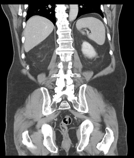 Adenocarcioma of rectum- T1 lesion (Radiopaedia 36921-38547 Coronal C+ portal venous phase 46).png