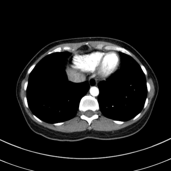 Adenocystic carcinoma of the trachea (Radiopaedia 47677-52525 Axial C+ arterial phase 69).jpg