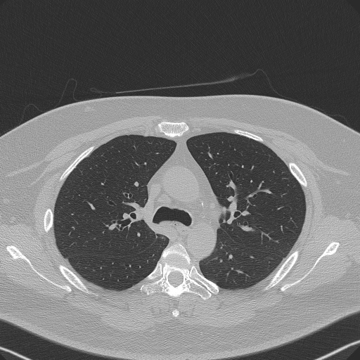 Adenoid cystic carcinoma of the trachea (Radiopaedia 49042-54137 Axial lung window 118).jpg