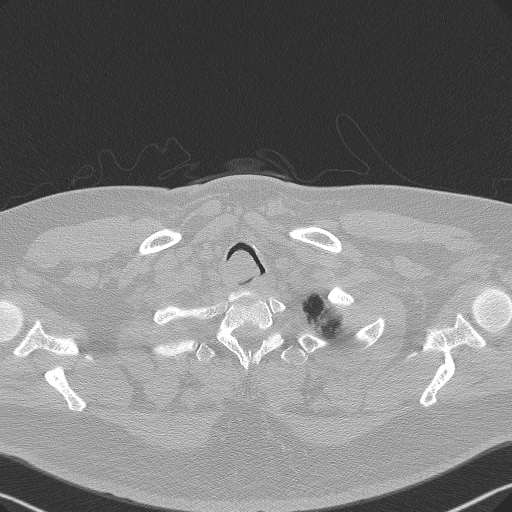 Adenoid cystic carcinoma of the trachea (Radiopaedia 49042-54137 Axial lung window 20).jpg